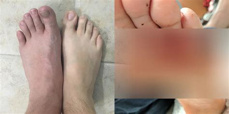 Use them in commercial designs under lifetime, perpetual & worldwide rights. This Man's Foot Infection Shows Why You Need Shower Shoes ...