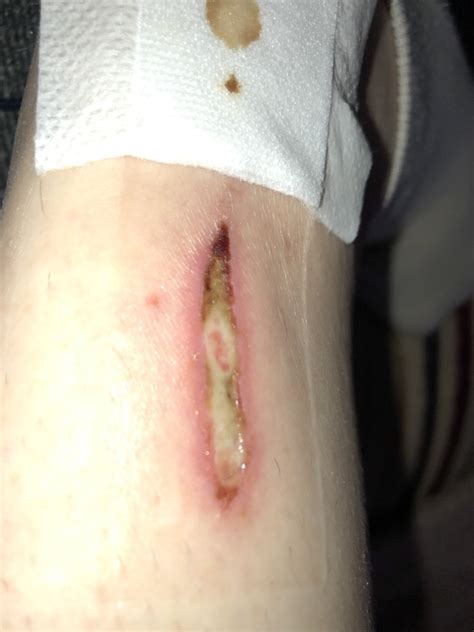 You have aches and pains or a fever. Infected cut (photo attached gross) | Mumsnet