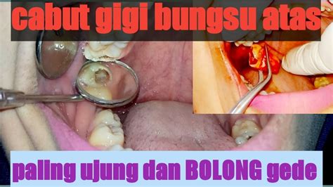 Berapa orang akan takut mendengarnya. Cabut gigi bungsu atas,berlubang besar dan paling ujung ...