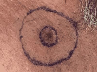 Squamous cell cancer, which starts in the top layer of the skin another kind of skin cancer is called melanoma. Difference Between Basal Cell and Squamous Cell Carcinoma ...