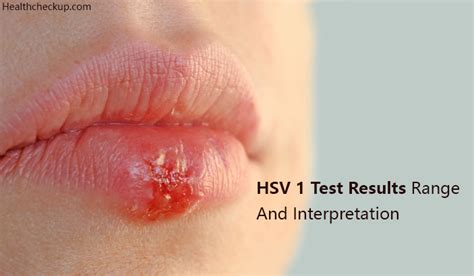 They also used the igm test but from what i have read it's not very reliable. HSV 1 Test Results Range And Interpretation - Health CheckUp