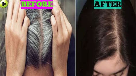 Progesterone therapy for hair loss. How to prevent white hair naturally at home within 7 days ...