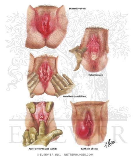 In males, it infects the lower urethra and, possibly, the prostate gland, seminal vesicles. Diabetic Vulvitis, Trichomoniasis, Moniliasis, and Gonorrhea