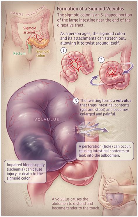 Maybe you would like to learn more about one of these? This JAMA Patient Page describes sigmoid volvulus, its ...