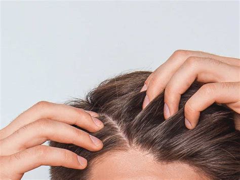 The disorder causes itching which results in the person rubbing or scratching the scalp. Seborrheic Dermatitis Hair Loss: Why It Happens and How to ...