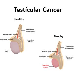 What are testicular cancer symptoms and signs? Testicular Cancer Causes, Symptoms, Diagnosis and ...