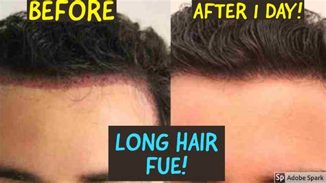 Exactly how long it takes for the transplanted hair to grow is highly individual and depends on many different factors, including the health of the client and the overall success of the hair transplant. LONG HAIR (UNSHAVEN) HAIR TRANSPLANT!! - YouTube