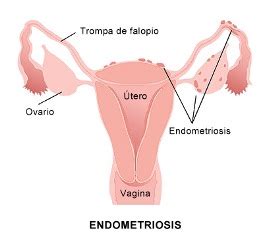 Endometriosis is a painful condition in which endometrial tissue grows outside the uterus, often in the pelvic area. Gejala Endometriosis - Penyebab dan Perawatan Secara Alami ...