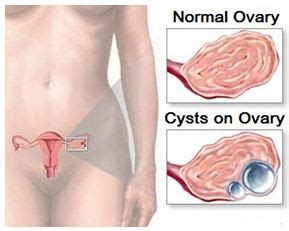 Neoplasms boleh menjadi sangat kecil, atau mereka boleh berkembang 15 cm atau lebih diameter. SHAKLEE: KECUTKAN KEWUJUDAN CYST DAN FIBROID DENGAN SHAKLEE