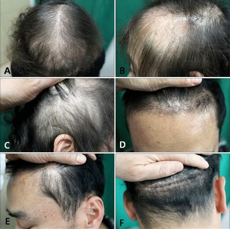 .hair loss, how diffuse hair thinning is part of pattern hair loss, and how a prp combination with extracellular matrix has successfully treated diffuse female address female pattern hair loss 6:39 — how hair regeneration positively affects the hair growth cycle 7:00 — how improvements from hair. Case 1. Some diffuse hair loss especially in the (A ...