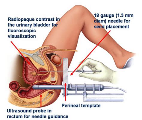 Prostate massage increases the flow of blood which helps in flushing out those bacteria. Auto Inspire: Coffee Cuts Risk of Prostate Cancer