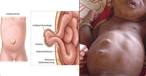 View 34 before and after umbilical hernia repair photos, submitted by real doctors, to get an idea of the results patients have seen. Umbilical Hernia In Babies: Causes, Symptoms, And Treatment
