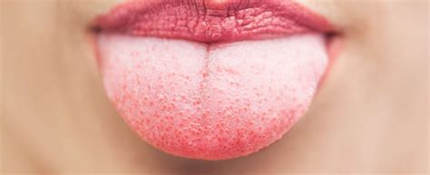 Learn more about head and neck cancer at ohsu knight cancer institute, including symptoms and stages of progression. 2021 - Tongue Cancer • Symptoms, Early Stage & Pictures