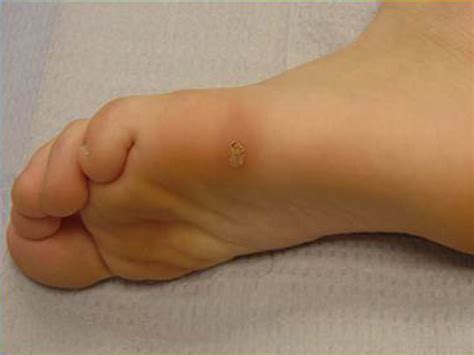 Warts on your feet are caused by an infection of the outer skin layer (epidermis) caused by hpv. Livermore Podiatry - Conditions : Warts