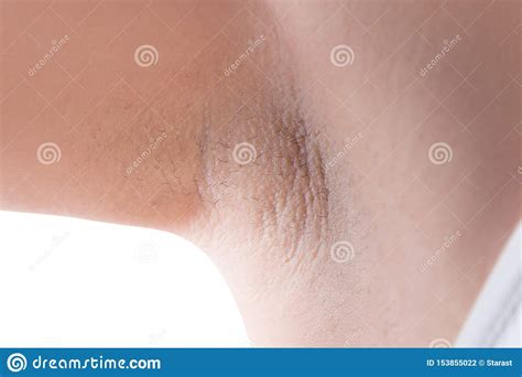 I underwent laser hair removal treatments to permanently remove my underarm hair even though i questioned whether that made me a bad feminist. Armpit Skin After Laser Hair Removal Stock Photo - Image ...