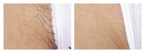 There's no irritation to the skin, so you can finally say goodbye to ingrown hairs and shaving. Hair Removal - Bikini Line - DermaSpark Products Inc.