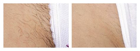 Patients will have less and less hair after each treatment. Hair Removal - Bikini Line - DermaSpark Products Inc.