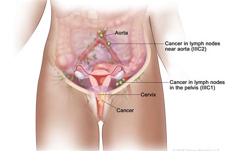 ■■ than before ■■ bleeding after going through menopause women may also notice… ■■ increased vaginal discharge ■■ pelvic pain ■■ pain during sex. CERVICAL CANCER : All You need to know - e-Clinic ...