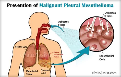 Mesothelioma is a rare cancer found in the mesothelium. Life Expectancy in Malignant Pleural Mesothelioma & its ...