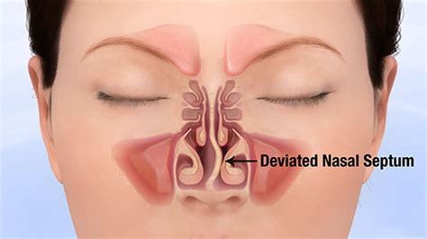 We did not find results for: The Problems a Deviated Nasal Septum Can Cause ...