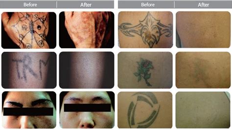 Upon conducting thorough research on the historic as well as current growth pa. Da Vinci Clinic - Birthmark & Tattoo Removal using Lutronic Spectra XT Laser