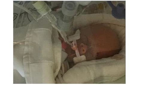 I have seen cases where surgery is done while still in the womb. Mom With Brain Tumor Who Refused Abortion Gives Birth to ...