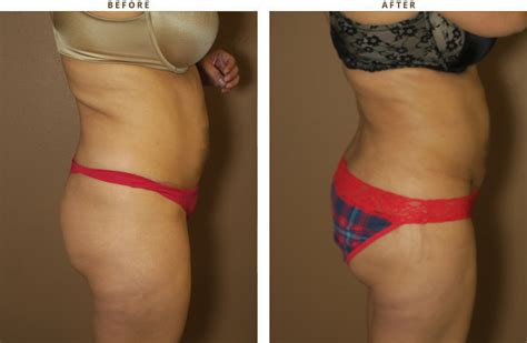 What is a brazilian buttock lift? Brazilian Buttock Lift - Before and After Pictures * | Dr ...