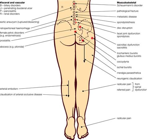 Sakit belakang tanda slip disc, punca,kaedah rawatan slip disc. SLIP DISC LUMBAR (SAKIT TULANG BELAKANG)