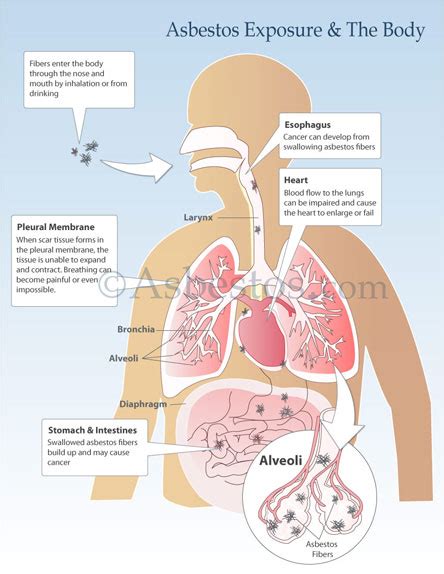 Check spelling or type a new query. Mesothelioma & Asbestos Images, Diagrams & Graphs