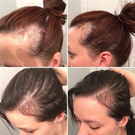 Here are the reasons behind your hair thinning. #testimonytuesday Postpartum Hairloss is a bummer ...