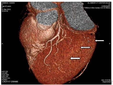 If a ramus intermedius artery is present, the diagonal arteries are less prominent and arise more distally. Number Of Diagonal Arteries / Coronary arteries | Coronary ...