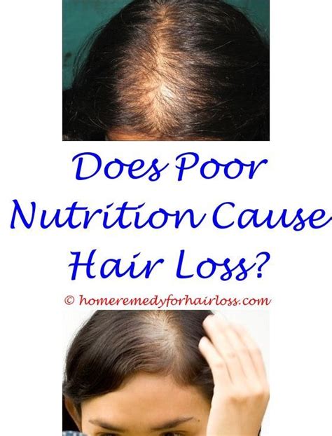 I have also dandruff and the level of dandruff increases when my body gets heated up. Pin on Hair Loss Tips