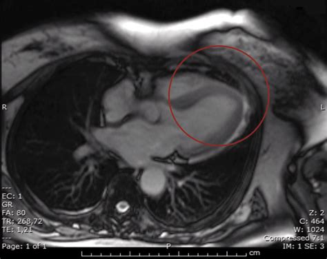 Trova gli specialisti più consigliati, risolvi i tuoi dubbi rivolgendo loro delle domande e prenota una visita online! Adult Still's disease and Tako-Tsubo syndrome | Cozzio ...