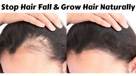 So please reaseash on this product deeply because it can be very harmfull for your hair's there are many companies in india who. Regrow Your Hair Naturally In Just 10 Days | STOP HAIR ...