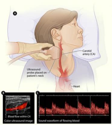 The left and right carotids, and the left and right vertebral arteries. How Many Carotid Arteries In The Neck - Clearing Clogged ...