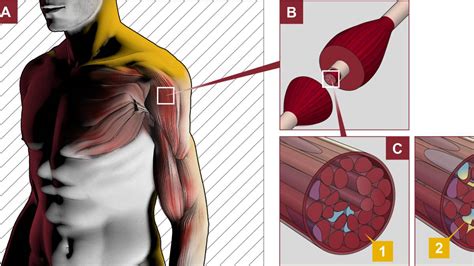 Vasculitis primaria del sistema nervioso central. Qué es la Enfermedad de Pompe, y por qué necesita ...