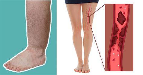 Pain in both the calf and thigh can occur with a dvt clot higher in the thigh. 9 Early Warning Signs Of A Blood Clot