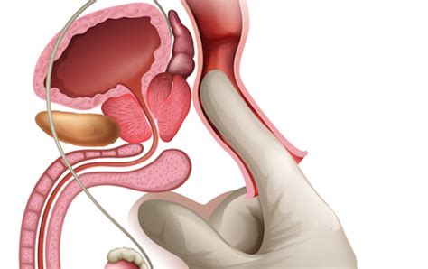 If you are overweight, get yourself on a diet and exercise plan that will get. Prostate massage therapy: Prostate orgasm and stimulation tips