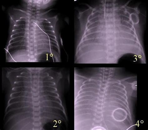 Hyaline membrane disease arises as a result of surfactant deficiency due to prematurity.105 although surfactant granules can be observed in lung cells at a gestational age. Bung Dyto