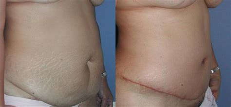 You may want this surgery if you have a flabby tummy. Tummy Tuck Before & After Photos Patient 33 | San ...