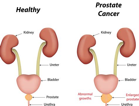It may come back in the prostate area again or in other parts of the body. Symptom of prostate cancer