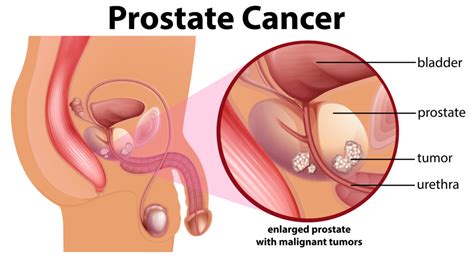 This can cause the urethra to narrow and decrease urine flow. What is Prostate Cancer - Checkyourtackle