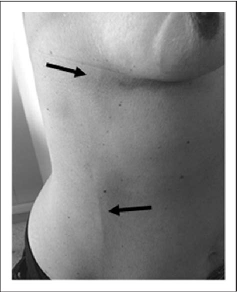 It sometimes occurs in the arm or penis. Figure 2 from Breast Mondor's disease: Diagnosis and ...