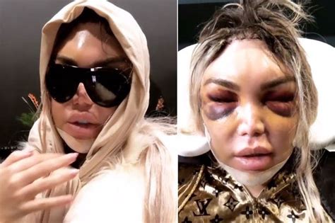 Página oficial do cantor rodrigo alves, diretamente da bahia para o brasil. Rodrigo Alves looks bruised and swollen after gruelling '£ ...