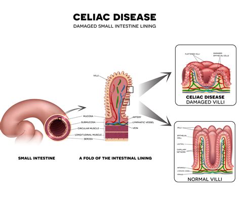 Free ceu resources openfree ceu resources. What is Celiac Disease? - Renee Matthews | Gluten Free ...