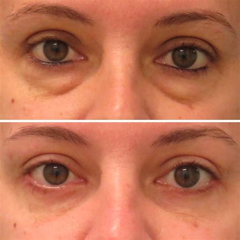 Upper and Lower Eyelid Surgery Before And After Photos | Dr.Kitto