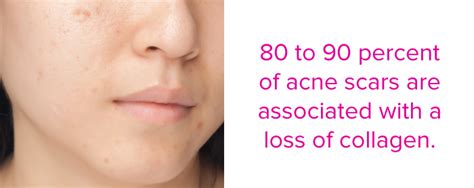 Terutama sekali 'parut berlubang' akibat memicit jerawat dengan kuku. Cara hilangkan parut jerawat berlubang di muka dengan ...