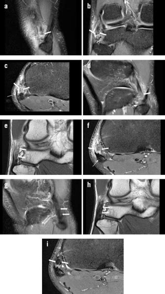 After a complete history including occupational hazards, review of symptoms, and prior trauma a complete a physical examination will be performed. Aspetar Sports Medicine Journal - Isolated fibular ...