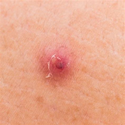 Infected ingrown hair removal ingrown hairs typically resolve on their own without removal. 8 Common Bumps On Your Skin You Should Never Pop