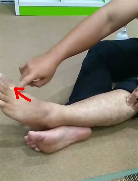 Umumnya asam urat sering menyerang jari tangan, pergelangan kaki, lutut hingga jari kaki. 3 POINT URUTAN SAKIT TAPAK KAKI & IBU JARI KAKI